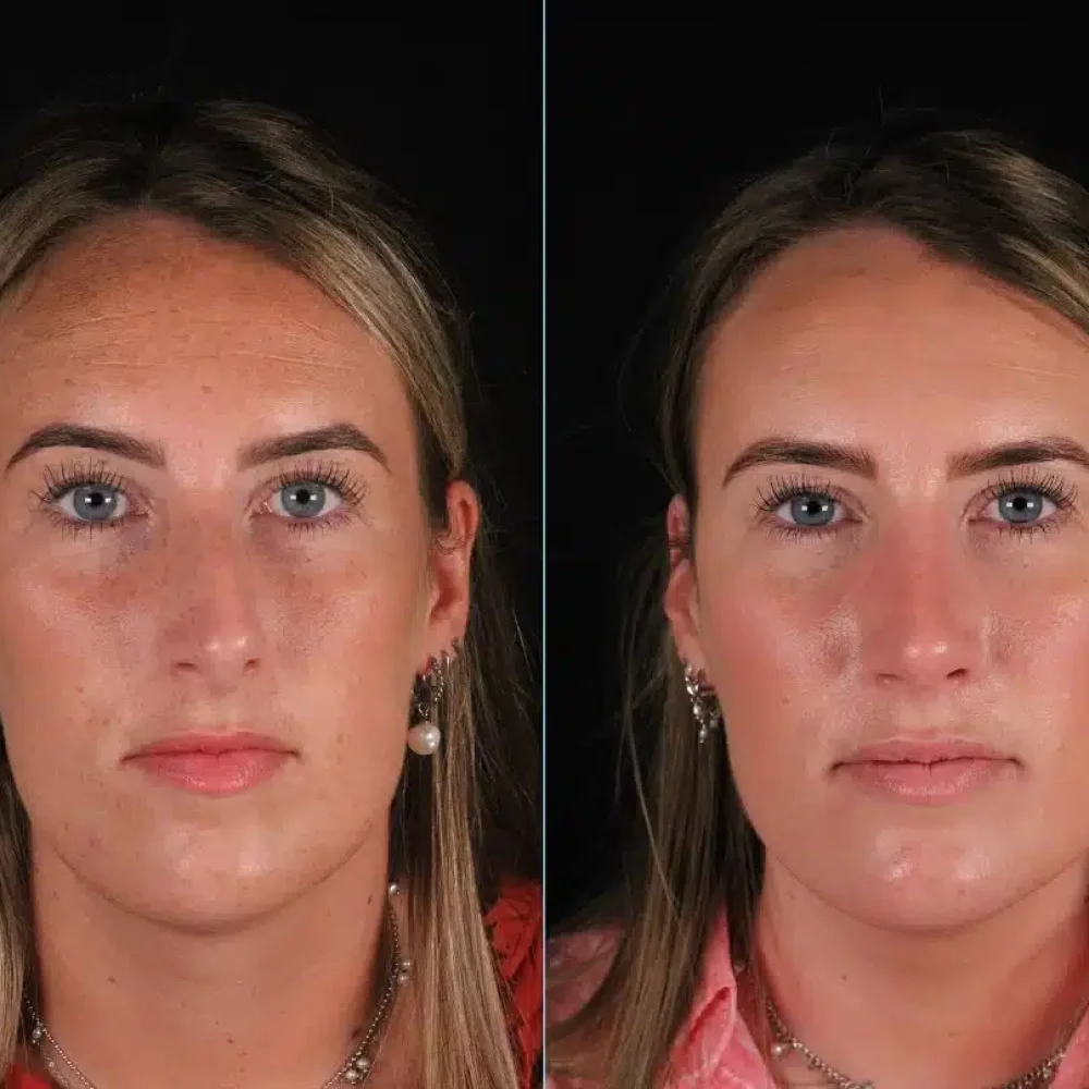 neuscorrectie-neus-rechtzetten-voor-na.jpg